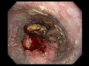 CÁNCER DE ESÓFAGO - ENDOGASTRO