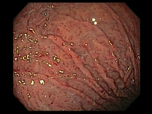GASTRITIS ENDOGASTRO PUNO