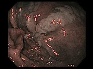 GASTRITIS ENDOGASTRO